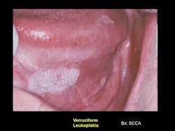 14aprfroumoralcancer01 14aprfroumoralcancer01