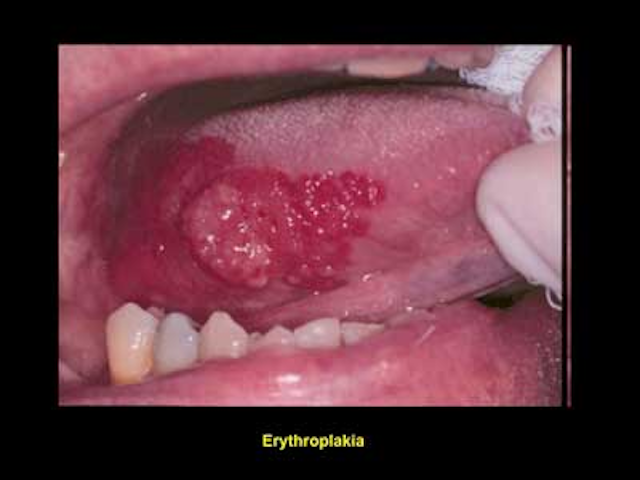 Human papillomavirus and oral cancer PerioImplant Advisory