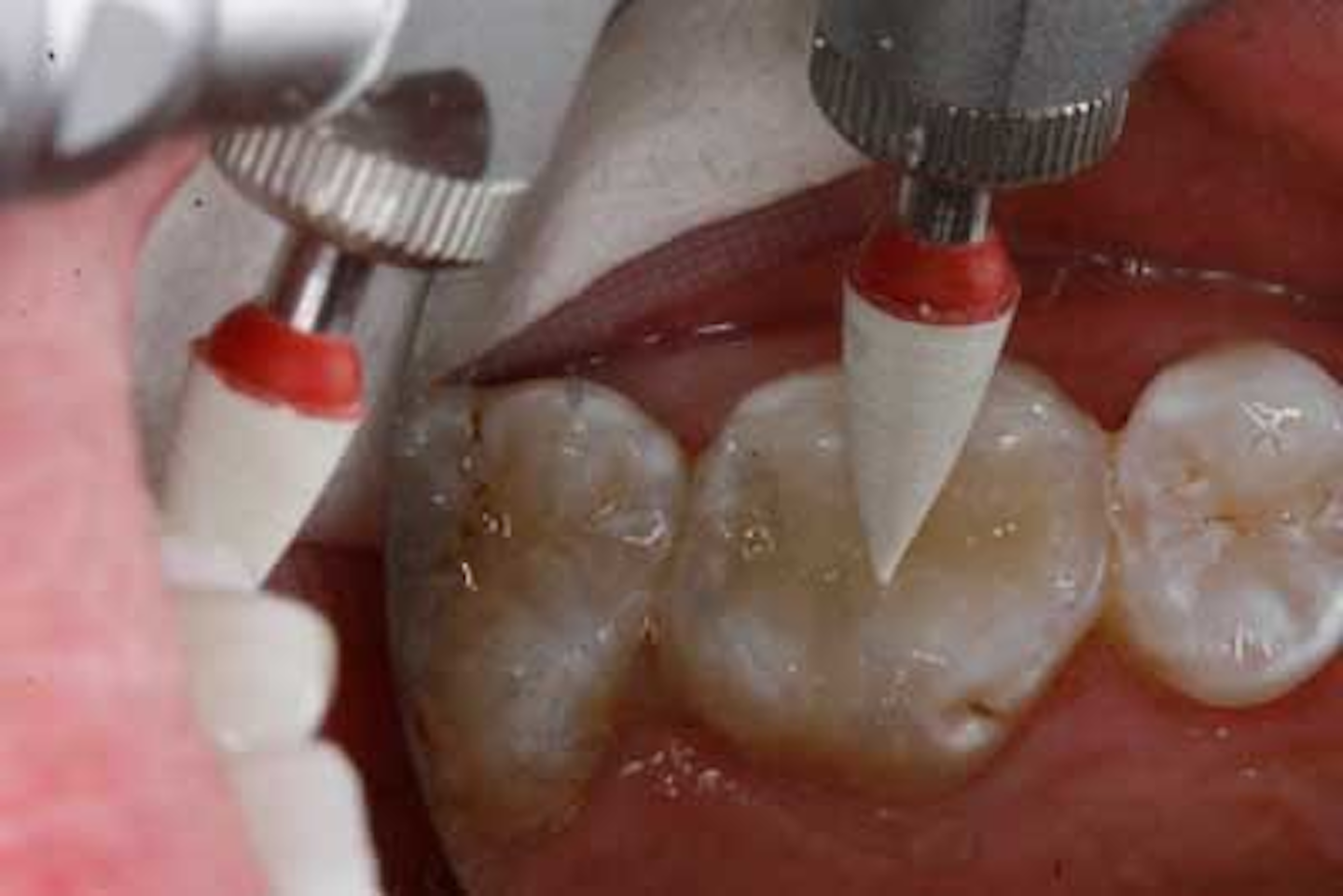 Bulk-fill composites: a step-by-step case presentation | Perio-Implant ...