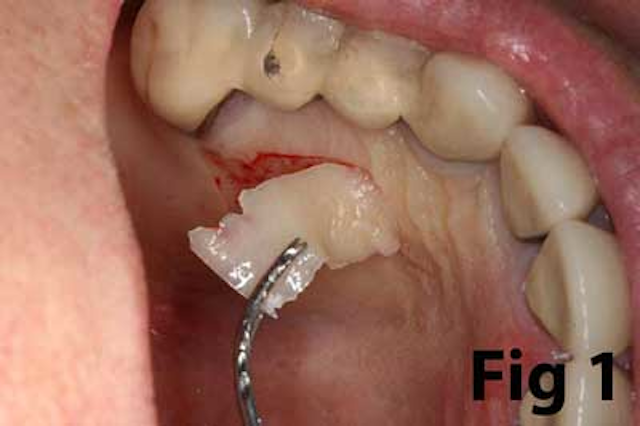 Attached gingiva and dental implants | Perio-Implant Advisory