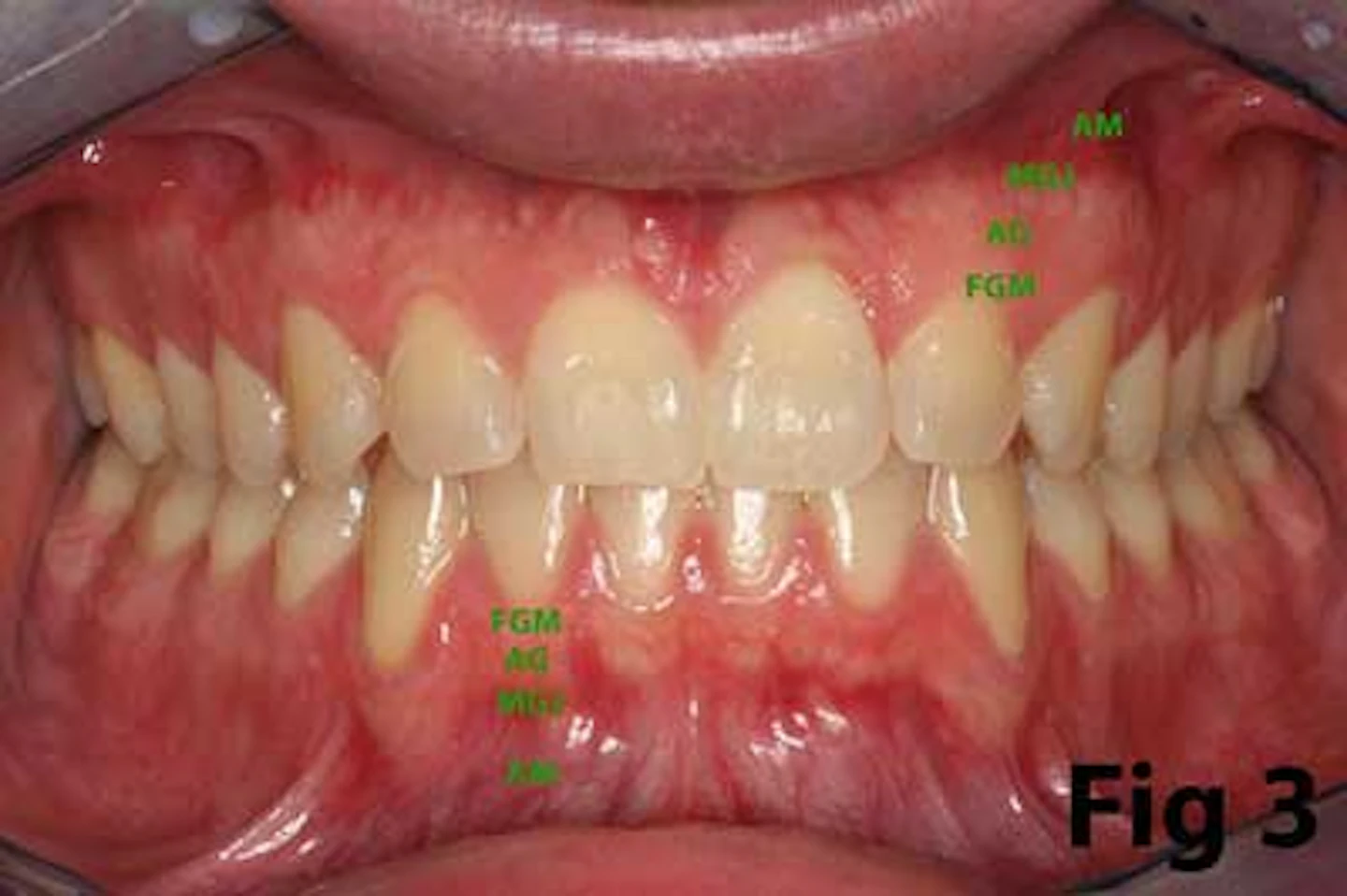 Attached gingiva and dental implants | Perio-Implant Advisory