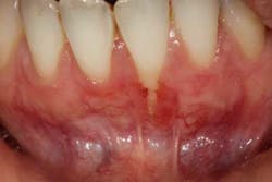 15mar26srrfroum Perioregen01 15mar26srrfroum Perioregen01