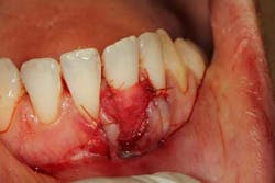 15mar26srrfroum Perioregen02 15mar26srrfroum Perioregen02