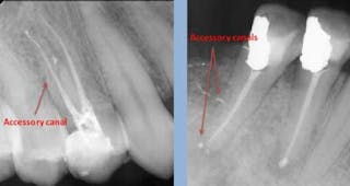 Step-by-step procedure to simplified and efficient root canal
