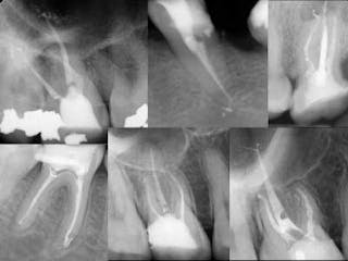 Step-by-step procedure to simplified and efficient root canal