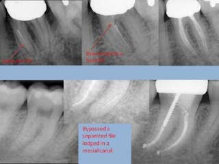 Step-by-step procedure to simplified and efficient root canal