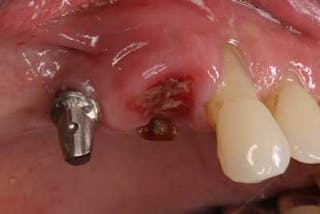 healthy socket after extraction