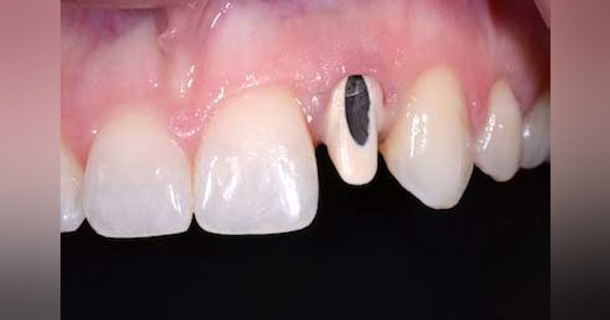 Close the access opening of implant abutments | Perio Implant Advisory