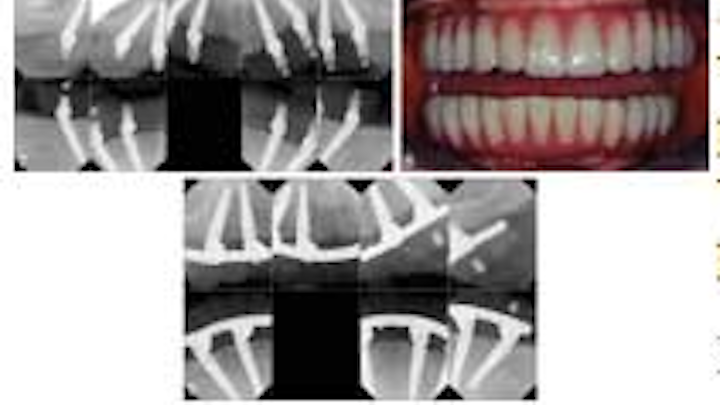 All On Four Implant