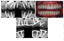 All On Four Implant All On Four Implant