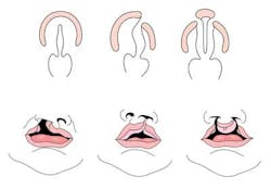 Cleft Lip Palate Dreamsteime Cleft Lip Palate Dreamsteime