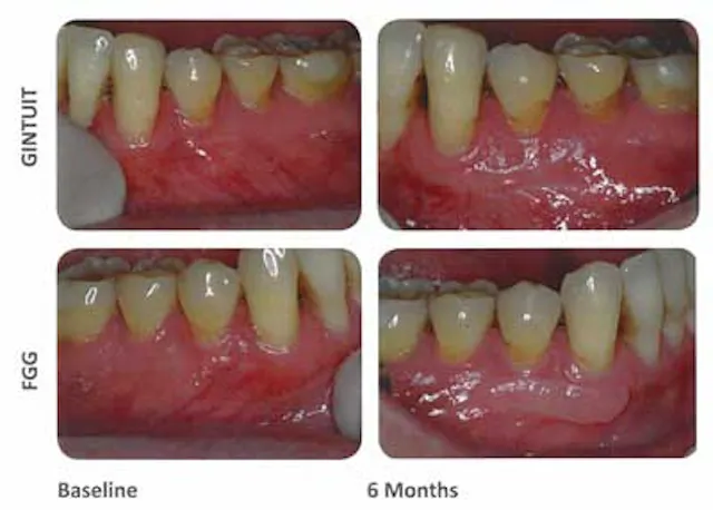 Is it time to retire the free gingival graft procedure in light of new ...