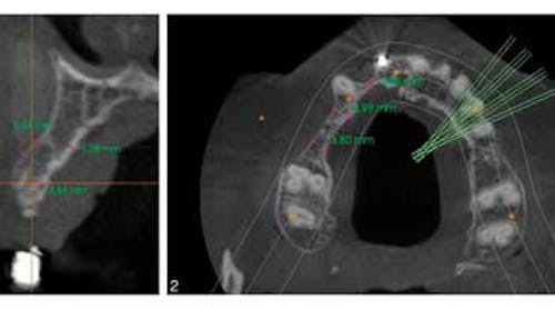 Ridge Augmentation | Perio Implant Advisory