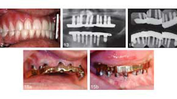 Longtermdentalimplanttxjoi