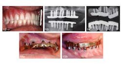 Longtermdentalimplanttxjoi Longtermdentalimplanttxjoi