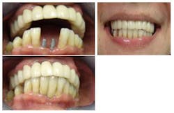 Narrowdiamimplantsfig11 14 Narrowdiamimplantsfig11 14
