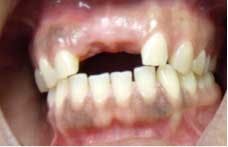 Narrowdiamimplantsfig2 Narrowdiamimplantsfig2