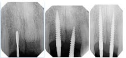 Narrowdiamimplantsfig3 5 Narrowdiamimplantsfig3 5