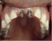 Narrowdiamimplantsfig6 Narrowdiamimplantsfig6