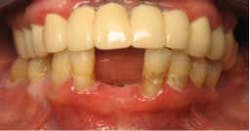 Narrowdiamimplantsfig9 Narrowdiamimplantsfig9