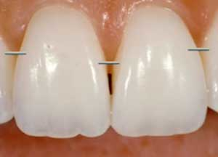 Openembrasure