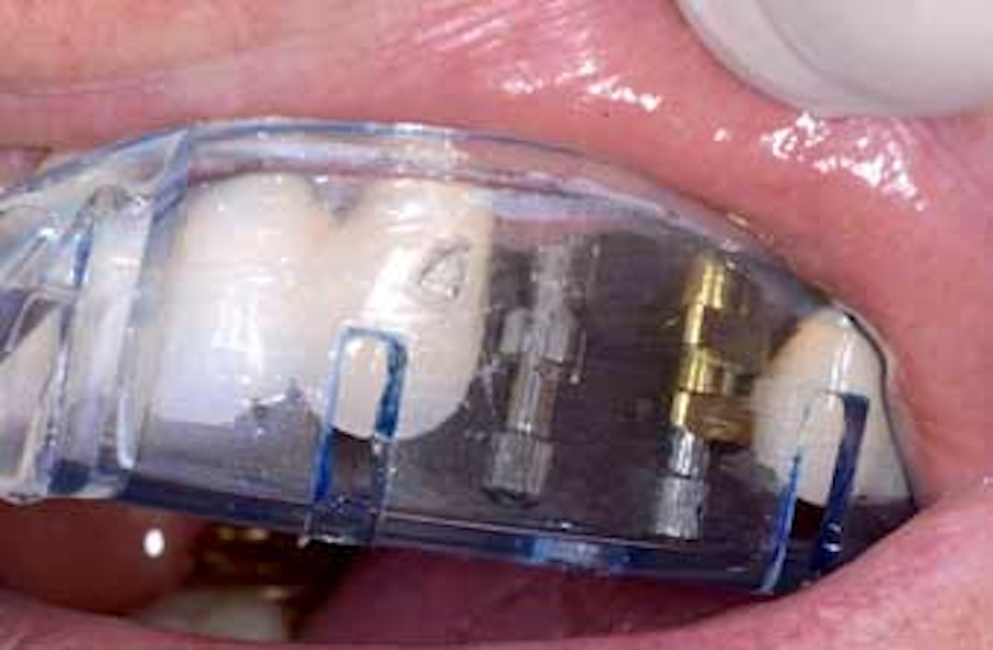 Using the open tray technique when impressing implant sites | Perio ...