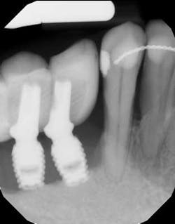 Peri Implant Bone Loss Scott Froum Peri Implant Bone Loss Scott Froum