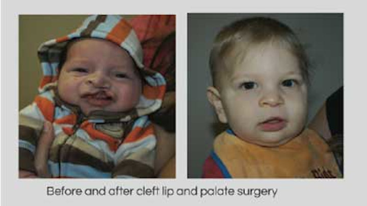 Quintencleftpalatesurgery