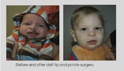 Quintencleftpalatesurgery Quintencleftpalatesurgery