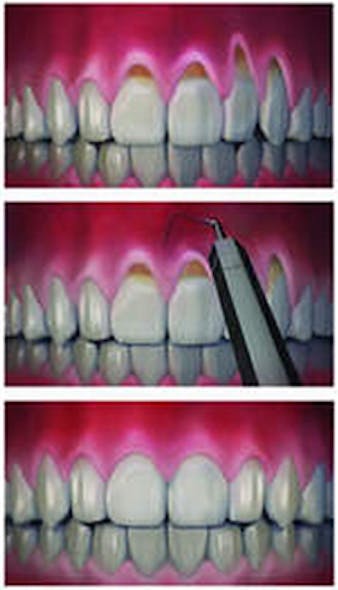 Receding Gums