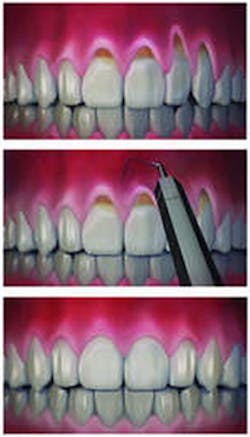 Receding Gums Receding Gums