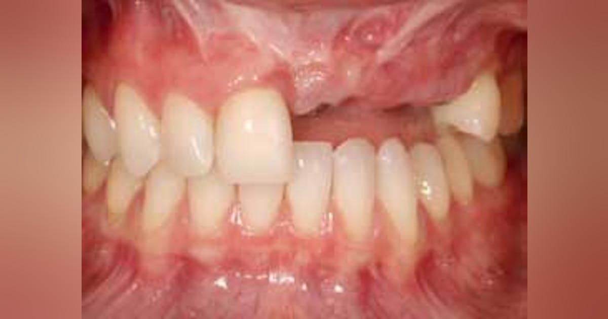 Replacement possibilities for multiple missing anterior teeth | Perio ...