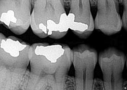 Simmonscariesjuly2013fig1 Simmonscariesjuly2013fig1