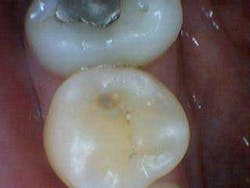 Simmonscariesjuly2013fig3 Simmonscariesjuly2013fig3