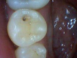 Simmonscariesjuly2013fig4 Simmonscariesjuly2013fig4