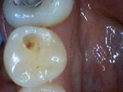 Simmonscariesjuly2013fig5 Simmonscariesjuly2013fig5