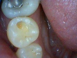 Simmonscariesjuly2013fig6 Simmonscariesjuly2013fig6