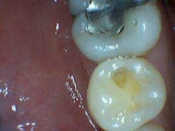 Simmonscariesjuly2013fig7 Simmonscariesjuly2013fig7