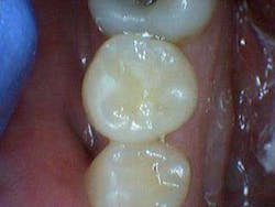 Simmonscariesjuly2013fig8 Simmonscariesjuly2013fig8