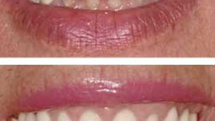 Spearflatperiodontium
