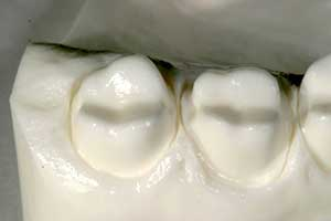 Cementation Of Full-contour Zirconia Restorations | Perio Implant Advisory