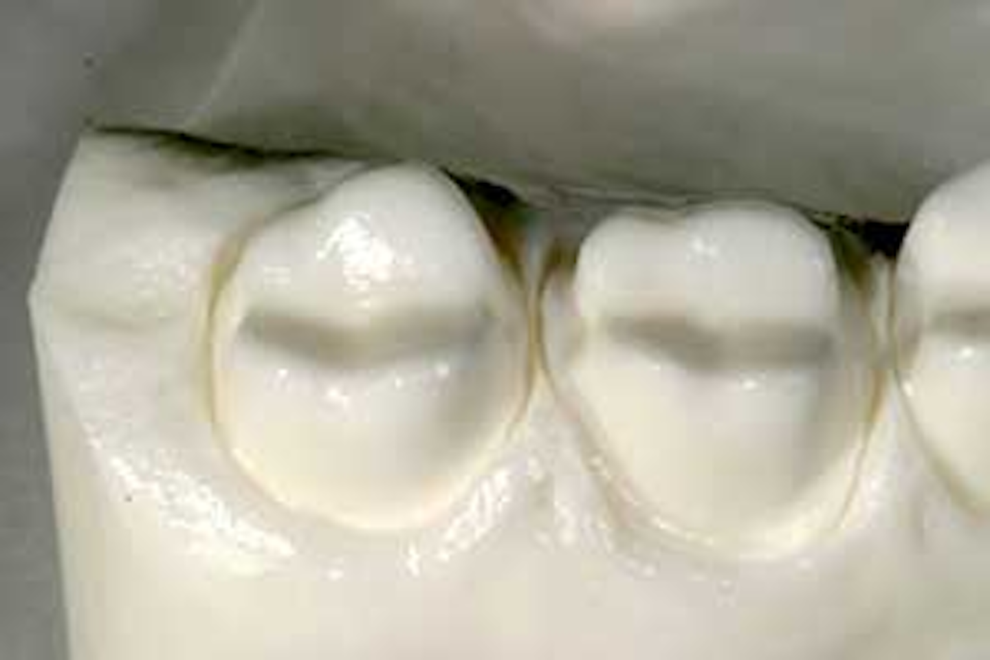cementation restorations cementing abutment