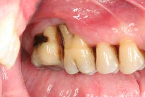 Saving Teeth They Must Not Teach That As The First Therapeutic Response In Dental School Perio Implant Advisory Saving Teeth They Must Not Teach That As The First Therapeutic Response In Dental School Perio Implant Advisory