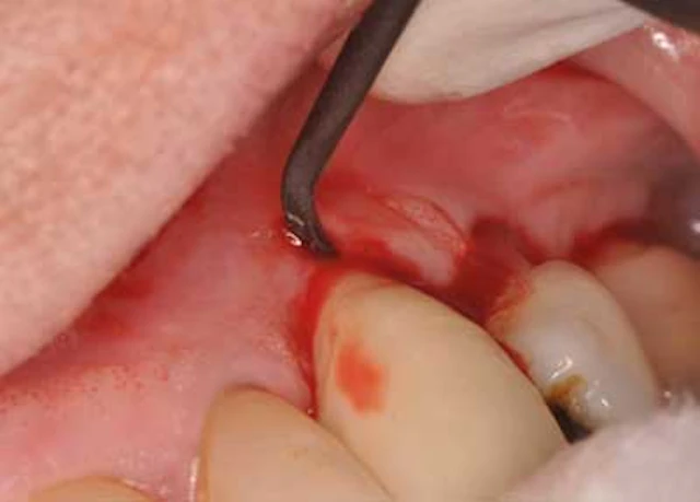 Peri implant Mucositis Are You A Clairvoyant Or A Charlatan Perio Implant Advisory