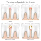 Stages Of Periodontal Disease