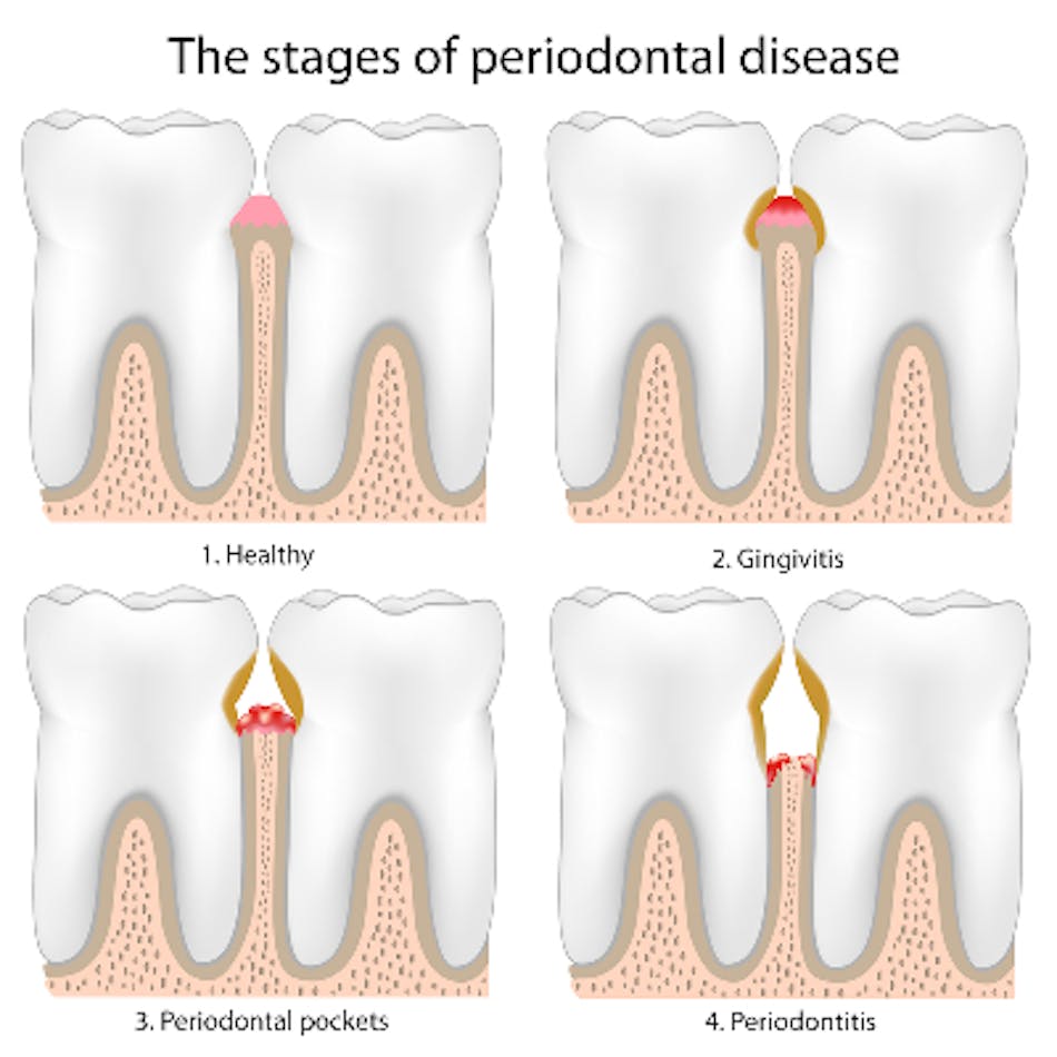 Stages Of Periodontal Disease