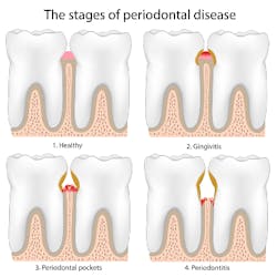 Stages Of Periodontal Disease Stages Of Periodontal Disease