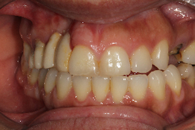 Deciding between pink porcelain versus ridge augmentation in the ...