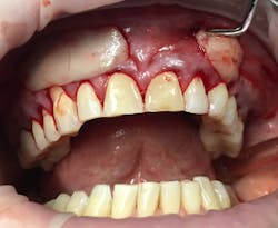 17apr13piagumdrop P13 17apr13piagumdrop P13