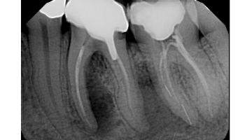 perio endo ask questions determining infections teeth upon